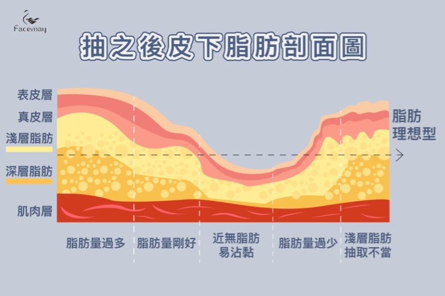 外輪廓固定