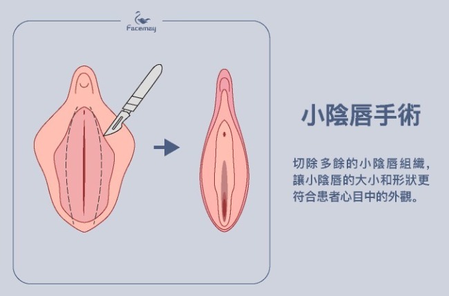 小陰唇手術