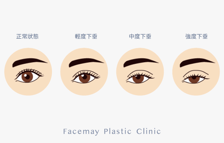 提眼肌手術時常會和雙眼皮手術合併施作，讓整體眼睛比例更加和諧。