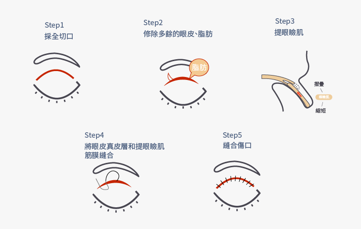 把提眼肌腱膜縮短或摺疊，加強提眼肌收縮時產生的力量，達到完全而且對稱性地打開雙眼。_工作區域 1